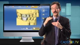 Parameters Impacting Occlusion for CEREC Bluecam and Omnicam [upl. by Berners873]