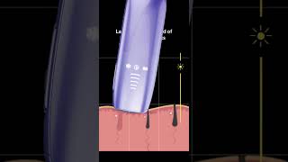 Why Choose IPL Hair Removal The Benefits of LightBased Technology Rxmoore IPL hair removal [upl. by Dorcus]