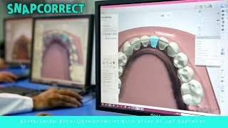 SnapCorrect  Worlds Clearest Aligners [upl. by Lenny]