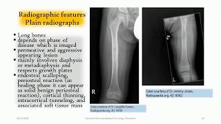 LangerhansCell Histiocytosis of the bone  ‘‘The great mimmicker’’ [upl. by Chapen]