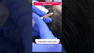 PRP HAIR LOSS PROBLEM skincare prp pigmentation hair hairloss alopeciahairloss beauty [upl. by Bruce525]