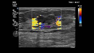 invasive ductal carcinoma [upl. by Dukie]