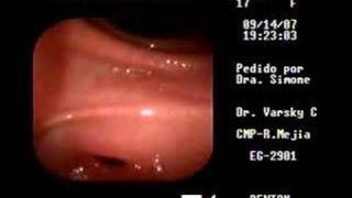 Endoscopia Digestiva Lizy [upl. by Kannry]