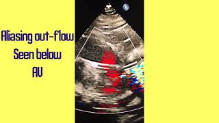 Impella Device TTE case of an Impella positional adjustment [upl. by Medora]