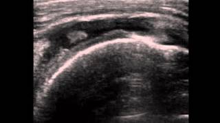 Supraspinatus Full Thickness tear on ultrasound [upl. by Notniw]