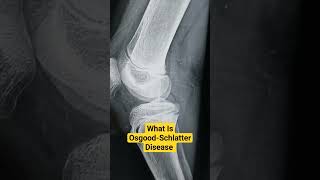 What Is OsgoodSchlatter Disease Dr Sai Chandra osgoodschlatterdisease [upl. by Yahc]