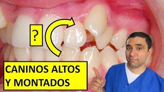 Tienes Dientes Altos😱  Mira como la Ortodoncia Los Arregla😎 [upl. by Satterfield]