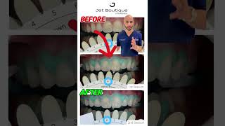 Teeth Whitening Transformation…In Only 40 Minutes [upl. by Hines]