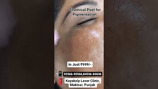 Chemical Peel for Pigmentation [upl. by Ayekat]