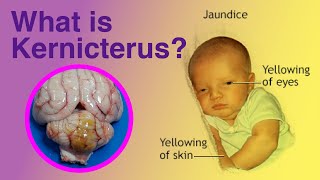 What is Kernicterus kernicterus [upl. by Carper]