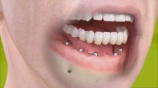 Straumann  Fixed restoration with 46 implants all straight [upl. by Ilojna40]