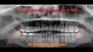 Extraction of Wisdom Teeth 17 amp 32 by DrKambiz Sadraei [upl. by Bartholomew]