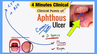 Aphthous Ulcer Explained Like Water  Symptoms Pathophysiology Treatment  Bengali Medicine Lecture [upl. by Fraya]