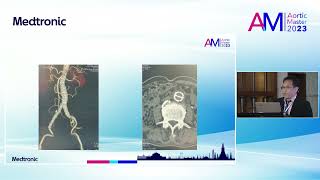 19 MAM2023 Is EVAR in Narrow Aorta using bifurcated stent graft safe and effectiveness [upl. by Suvart]