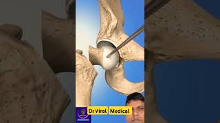 hip bone riplasment surgery orthoortho surgen medicalmedicinedrviralmedical [upl. by Suirrad]