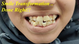 Severe Crowding Braces Treatment Before amp After Orthodontic Rx Smile Transformation  Dr Ram MDS [upl. by Kimberlee]