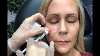 Dermal Filler Under Eyes Tear Trough Restylane and Radiesse [upl. by Aleka]