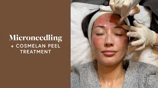 Microneedling Treatment amp Cosmelan Peel For My Melasma  Susan Yara [upl. by Mcquoid739]