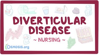 Diverticular disease Clinical Nursing Care [upl. by Revlis662]