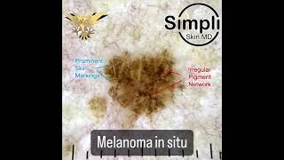 Melanoma in situ [upl. by Aranahs]