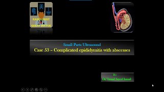 Ultrasound Case 53  Complicated Epididymitis with Abscesses and Pyocele [upl. by Akinom]