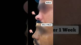 Rhinoplasty Surgery Result After 1 Week  Nose Job Transformation [upl. by Eckhardt]