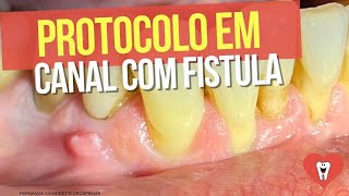 ENDODONTIA PAREI DE ERRAR EM CASO DE FÍSTULA  Endolovers [upl. by Ulysses941]