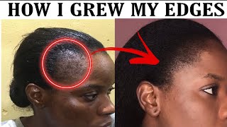 HOW TO GROW EDGES BACK THE NATURAL WAYHOME REMEDYHAIR JOURNEY [upl. by Suivatram]