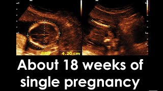 About 18 weeks 5 days 12 days of single viable pregnancy with breech presentation [upl. by Sandeep690]