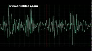 Atrioventricular Septal Defect AVSD [upl. by Ginnifer956]