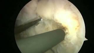 Arthroscopic Latarjet  BristowLatarjet Instability Shoulder System [upl. by Eded]