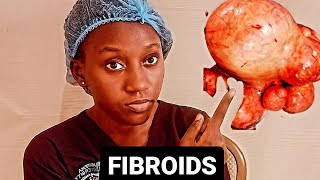 FIBROIDS What is the Cause Tell Signs Medication Options Available amp When to Opt for Surgery [upl. by Drain]