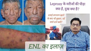 Leprosy  Erythema Nodosum Leprosum  दवाई लगातार खाने के बाद भी बुखार दर्द वाले दाने क्यों ENL [upl. by Rafaelia715]