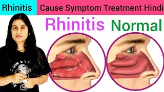 Rhinitis Type Cause Symptom Diagnosis Treatment in Hindi  What is Rhinitis  Treatment of Rhinitis [upl. by Etty]