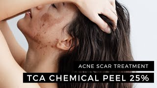 Enerpeel TCA Chemical Peel 25 2 Layers Acne Scar Treatment [upl. by Norak]