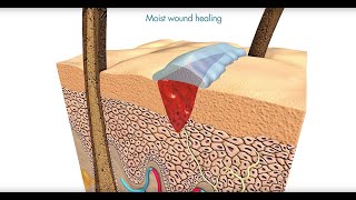 Flamigel  Optimal moist wound healing with Flamigel [upl. by Searcy]