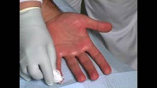 Botox for PALMAR Hyperhidrosis sweatypalms Dr David Pariser International Hyperhidrosis Society© [upl. by Ayotahs130]