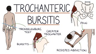 Understanding Trochanteric Bursitis [upl. by Dud540]