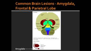 Common Brain Lesions  Amygdala Frontal amp Parietral Lobe [upl. by Anavoj289]