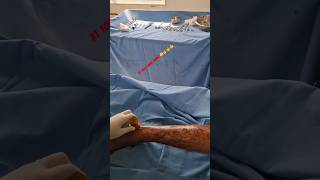 Rt foot biopsy Shorts youtubeShorts trending youtuber Shortstiktokyoutubegrowth [upl. by Fisk]