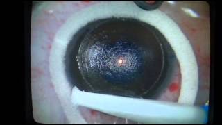 Femto Lasik with Alcon LensX and Wavelight EX500 Excimer Laser  ProfDr Pandelis Papadopoulos [upl. by Halbert443]