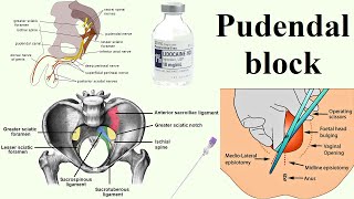 pudendal block [upl. by Deny]