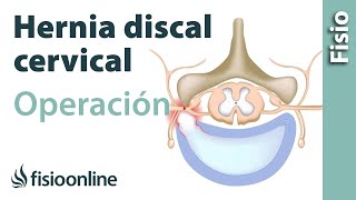 Hernia discal cervical Operación quirúrgica o cirugía [upl. by Ettevroc]