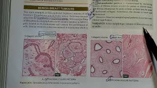 Fibroadenoma fully Explained Pathology ⚕️ [upl. by Mufinella]