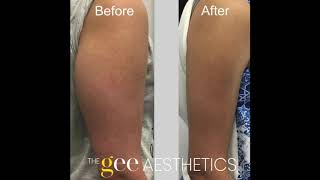 Cryolipolysis Prime Body Treatment  The Gee Aesthetics The FortBGC [upl. by Anilyx]