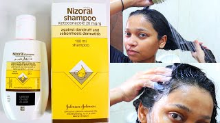 How to use Nizoral shampoo for effective results [upl. by Ahsat]