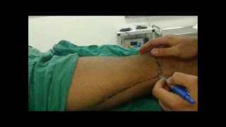 Lateral approach popliteal sciatic block  Peripheral nerve stimulator PNS [upl. by Eissirc474]