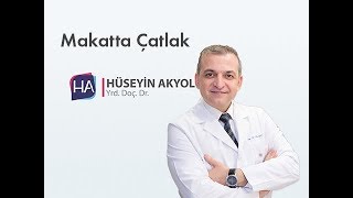 Makatta Çatlak Anal Fissür [upl. by Drarreg668]