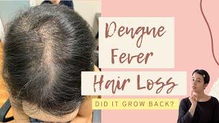 DENGUE FEVER HAIR LOSS  Telogen Effluvium  Female Hair Loss [upl. by Portie]