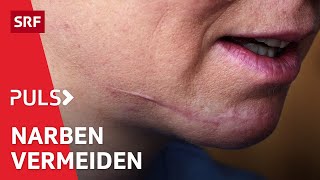 Wunden pflegen mit Narben leben – So hinterlassen Hautverletzungen weniger Spuren  Puls  SRF [upl. by Edwards]